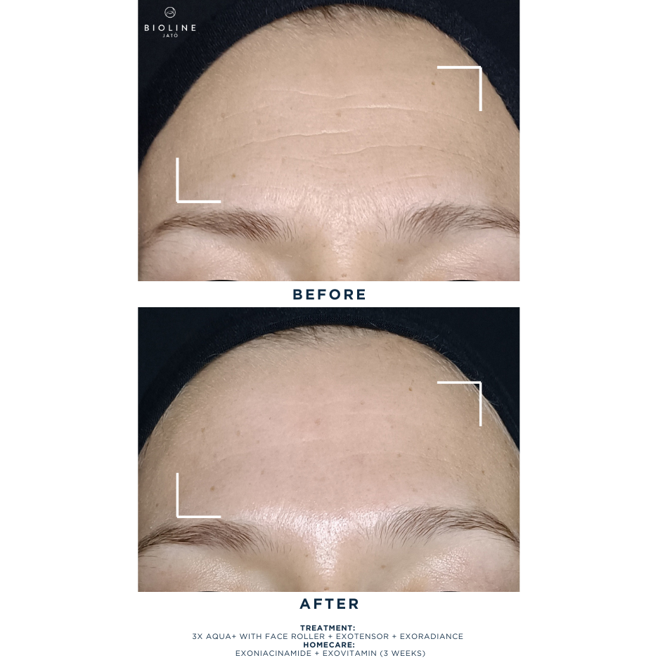 Exoniacinamide Booster Serum