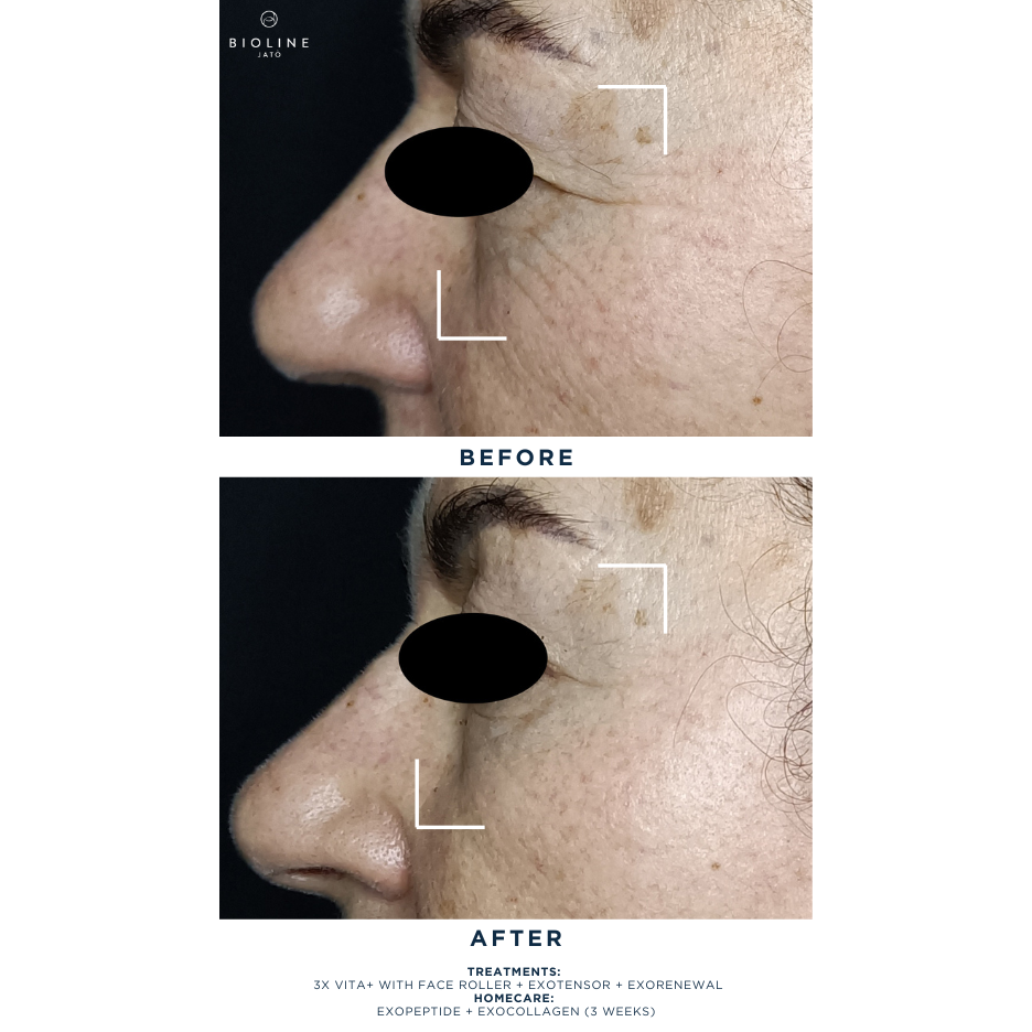 Exopeptide Booster Serum Sample