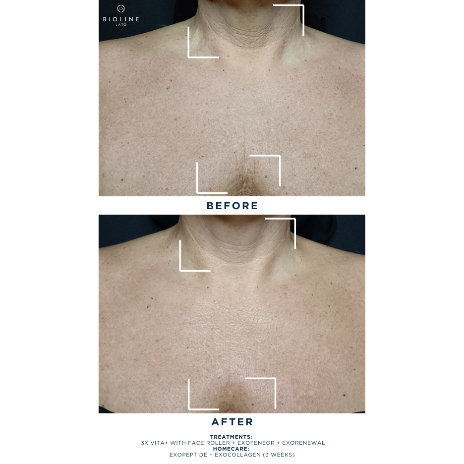 Exocollagen Booster Serum
