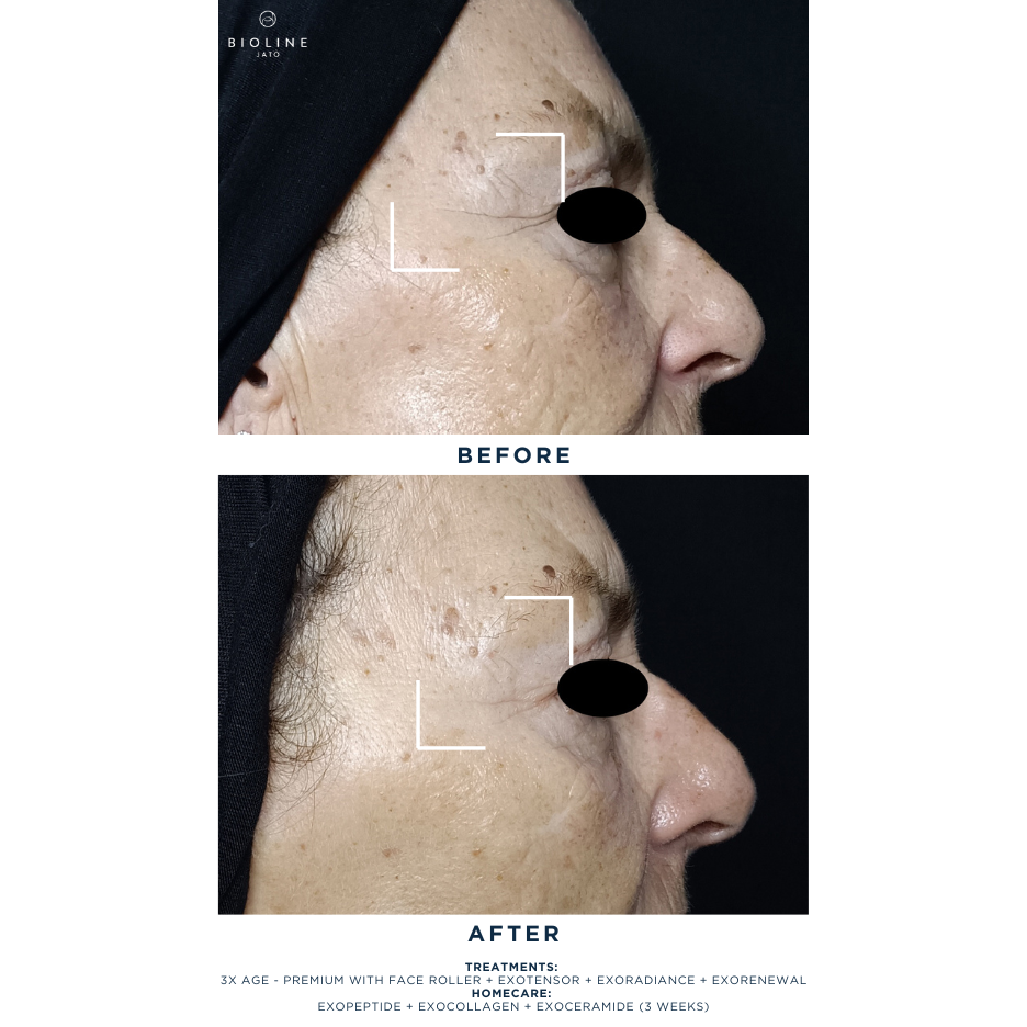 Exoceramide Booster Serum Sample